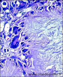 Microcristaux d'urate Microcristaux d'urate